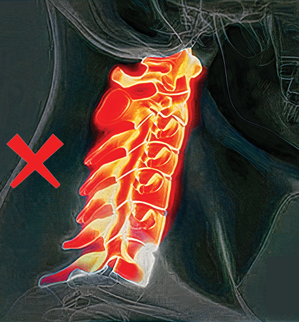 颈椎偏直 Cervical deviation