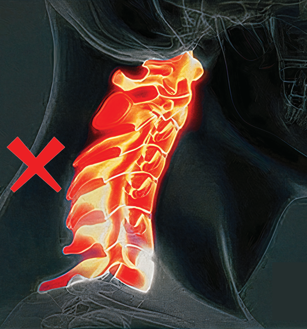 颈椎移位 Cervical displacement