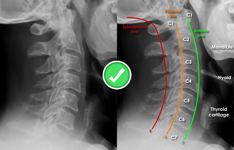 正常的颈椎弧度 cervical curvature